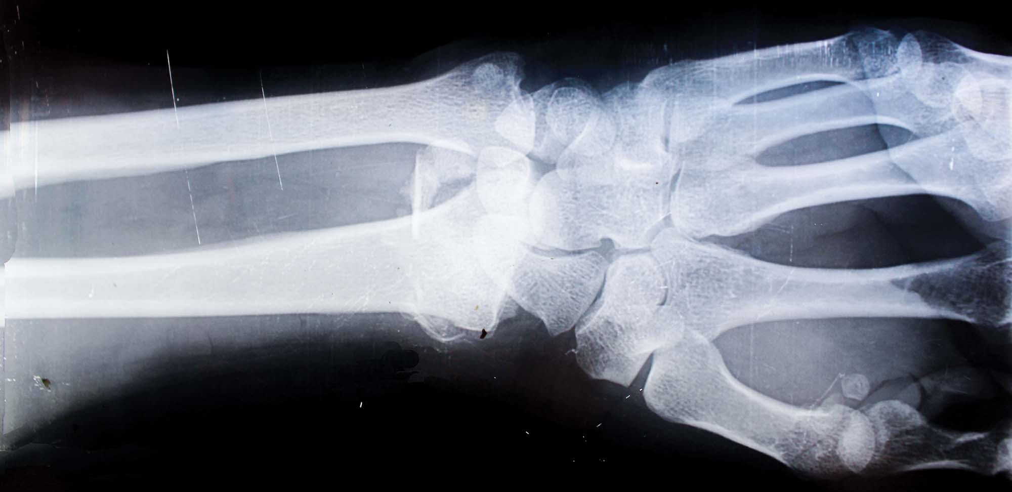 Photo of an xray of a forearm and hand